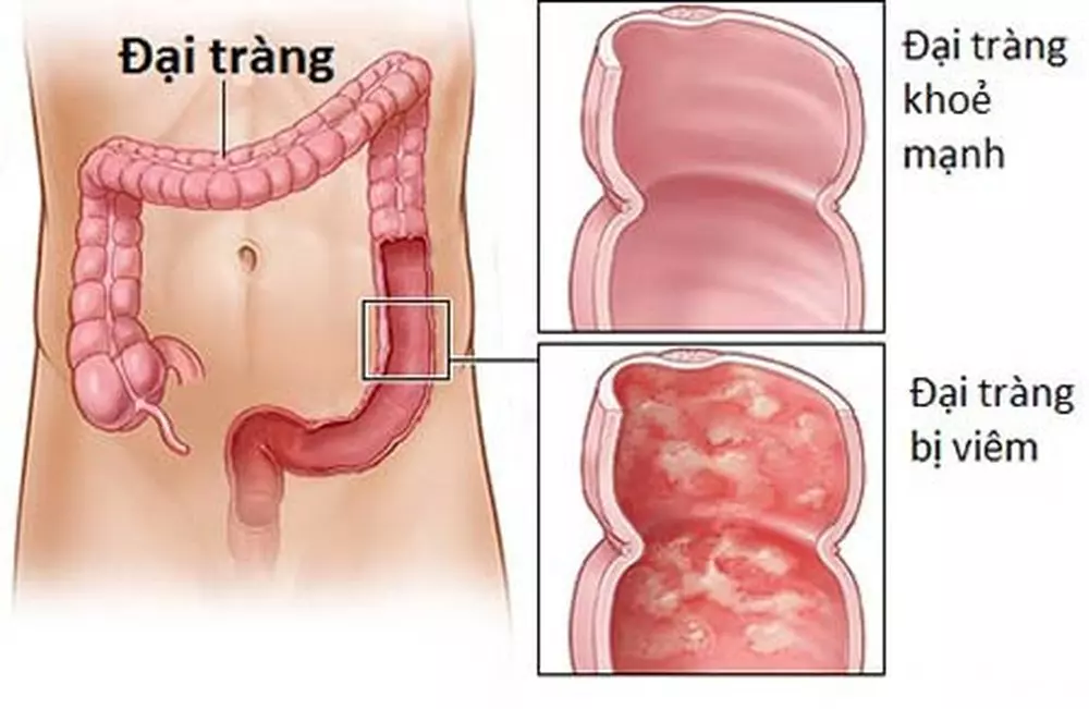 Viêm loét đại tràng không điều trị tốt có nguy cơ dẫn tới ung thư.webp